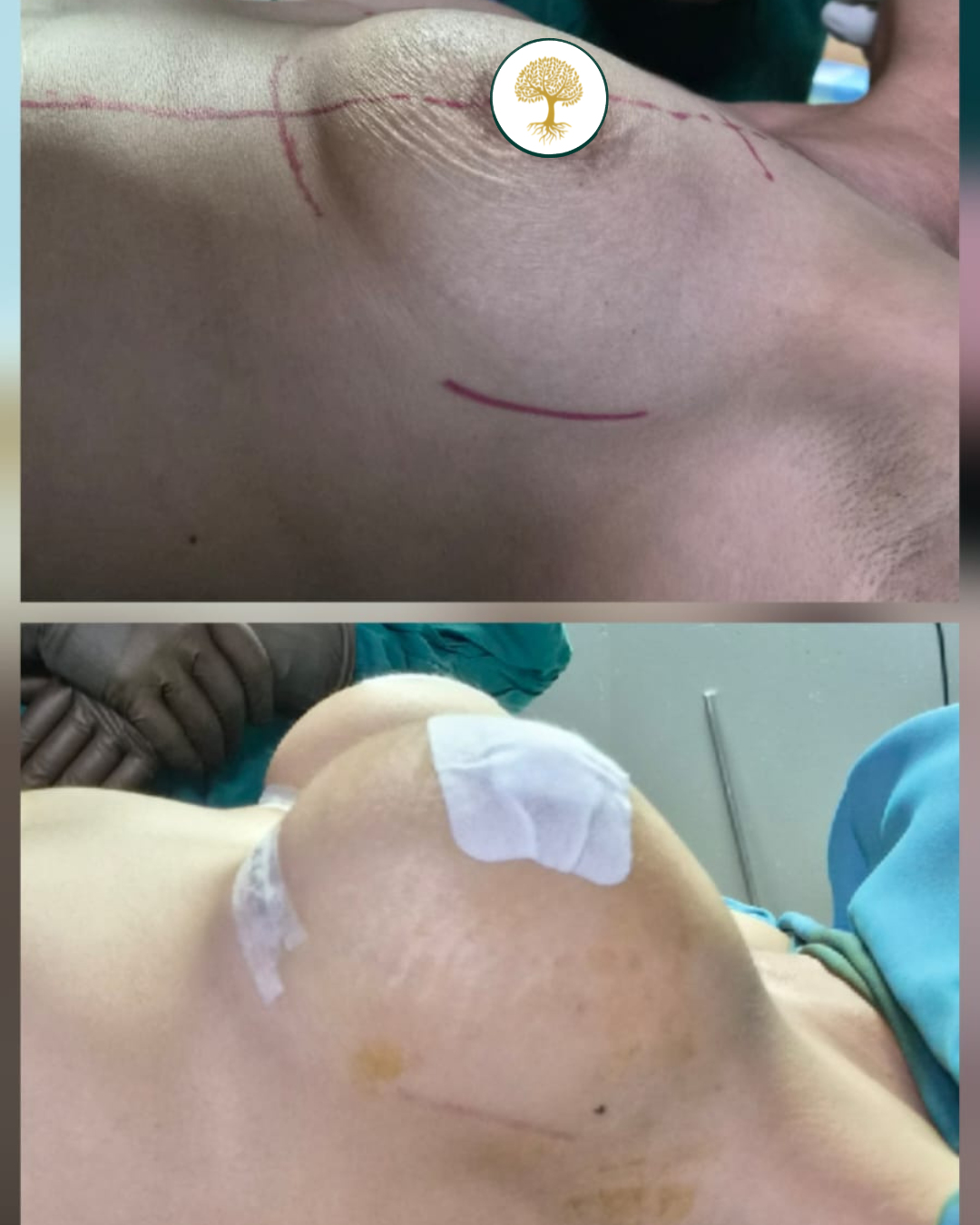 Before and after — Breast Augmentation