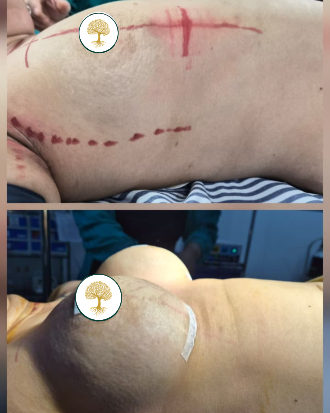 Before and after — Breast Augmentation