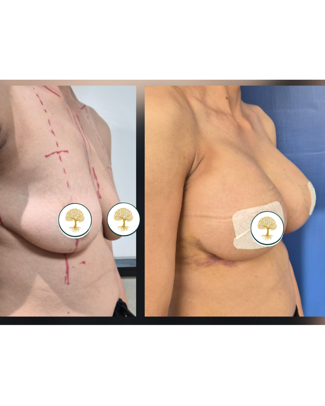 Before and after — Breast Lift
